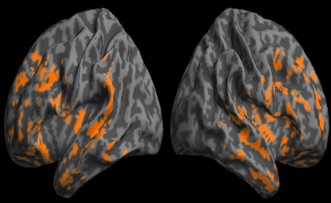 The Neural Basis for Frontotemporal Degeneration